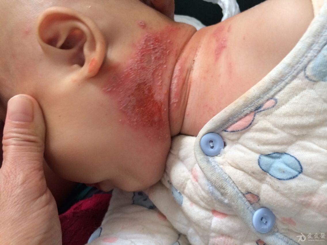 婴儿隐翅虫皮炎