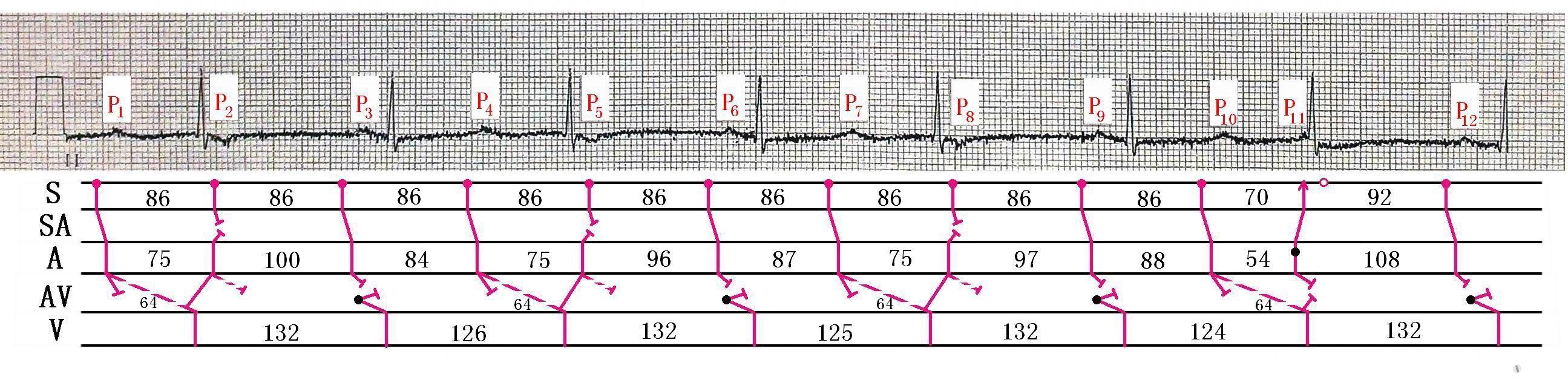 心电图有奖读图第 36 期(公布参考答案)