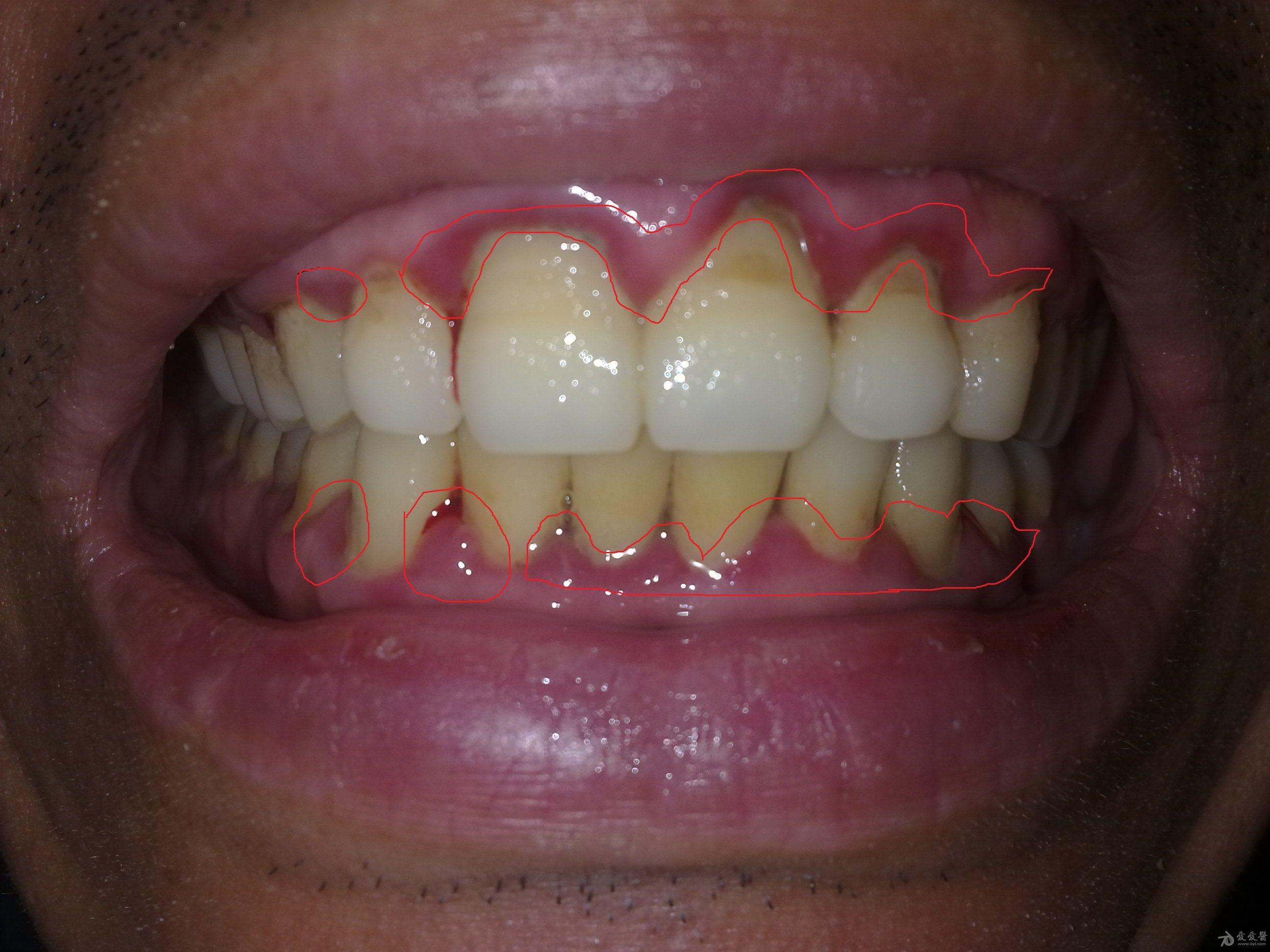 上下门牙牙龈红肿,出血半年多,求怎么治疗(有实拍图片 口腔医学