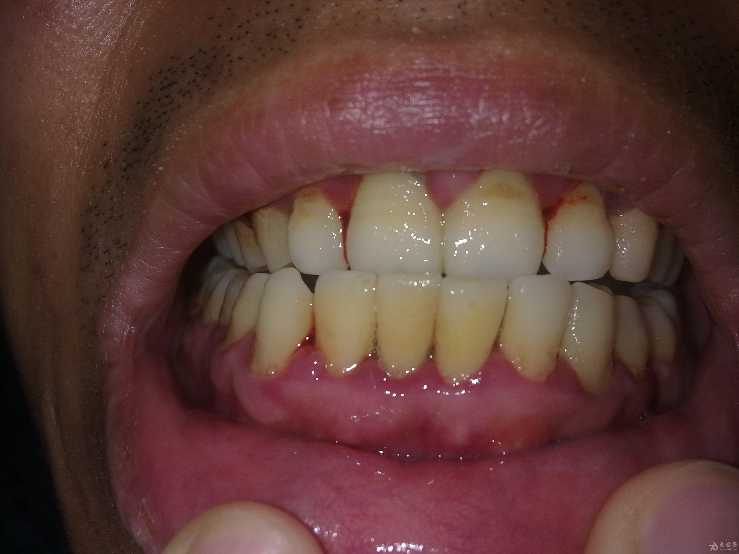 上下门牙牙龈红肿出血半年多求怎么治疗有实拍图片