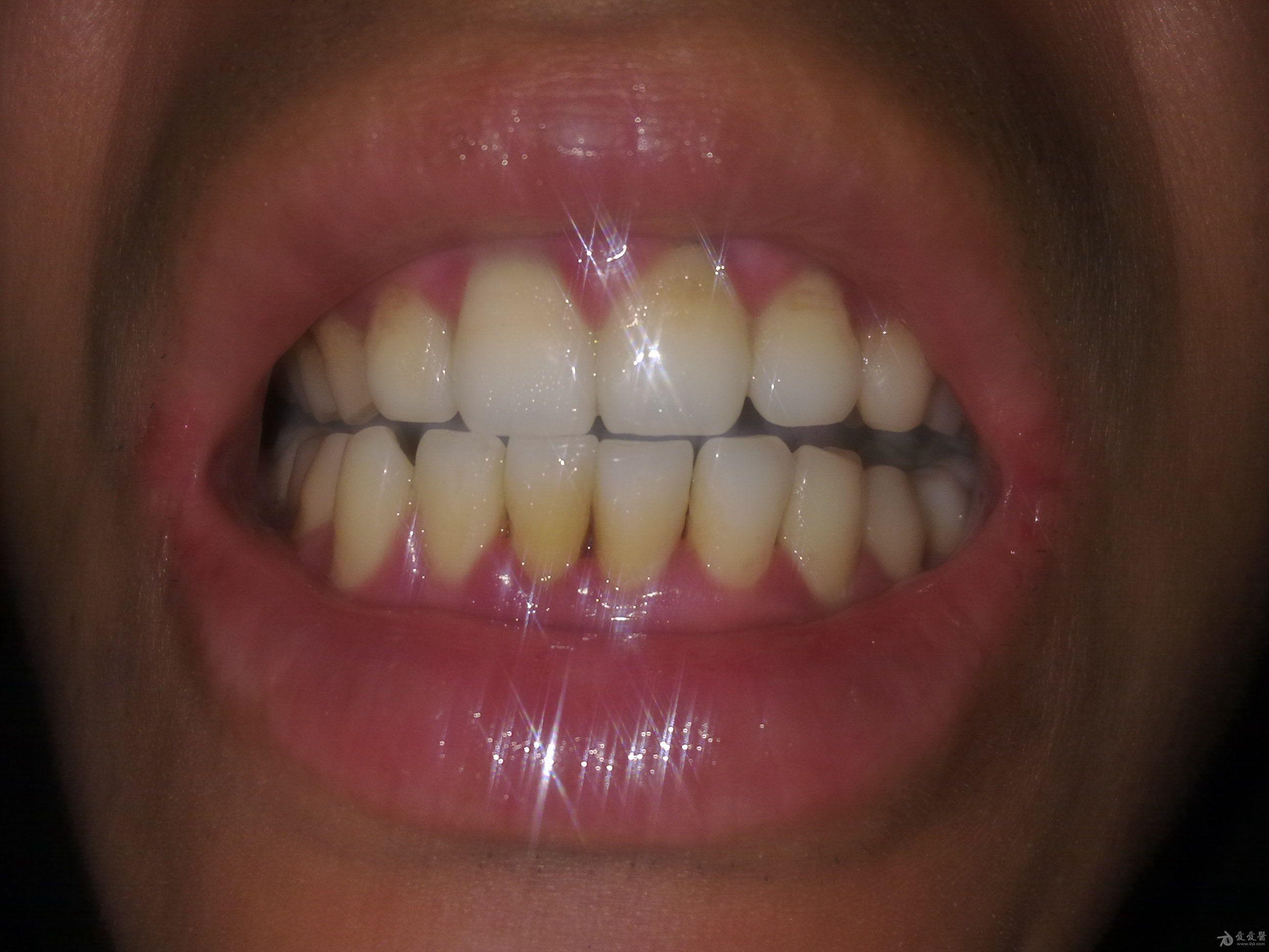 上下门牙牙龈红肿,出血半年多,求怎么治疗(有实拍图片)