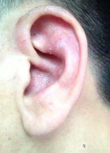 耳朵丹毒的症状图片图片