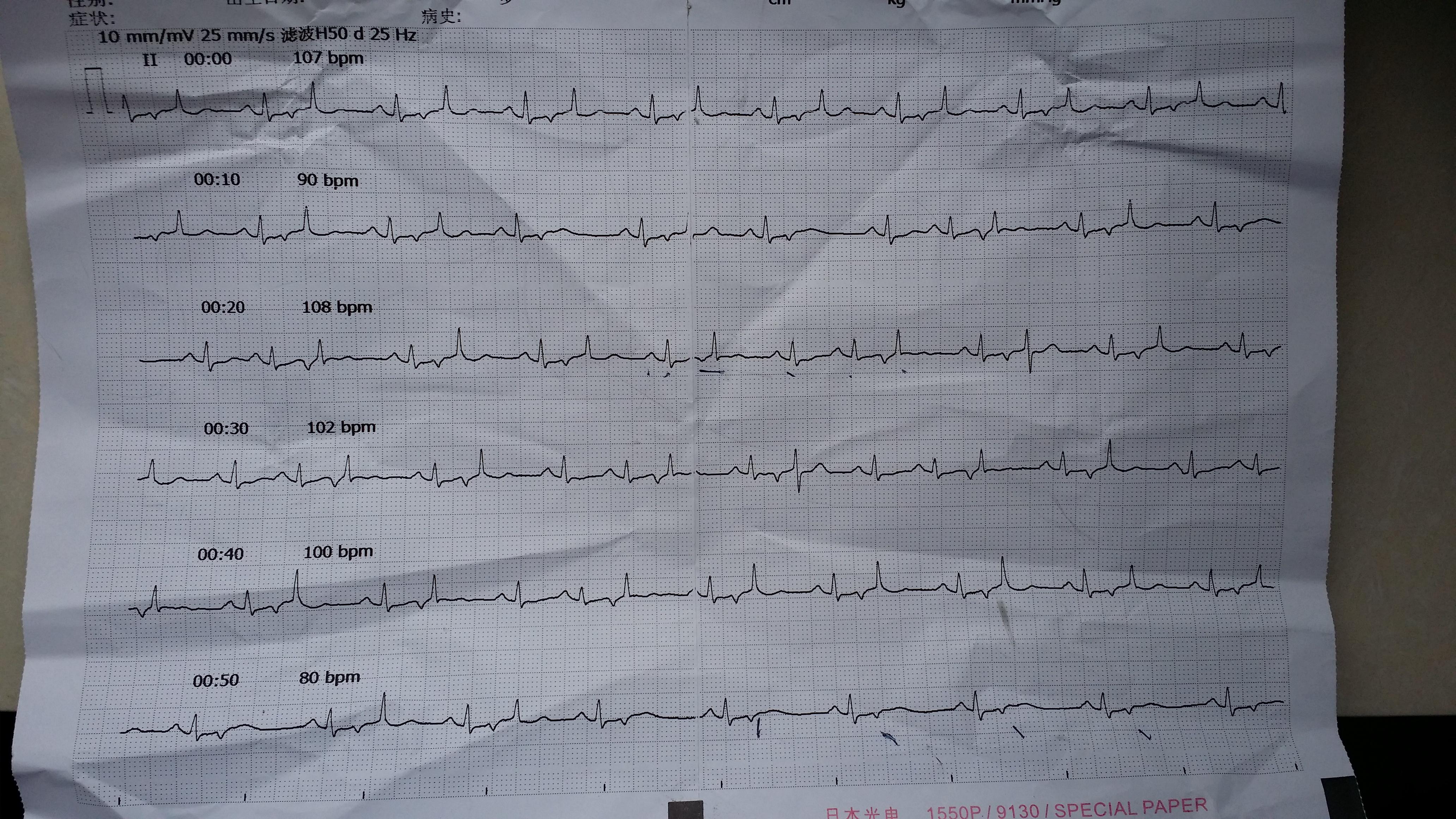 看看是什么心律不齐