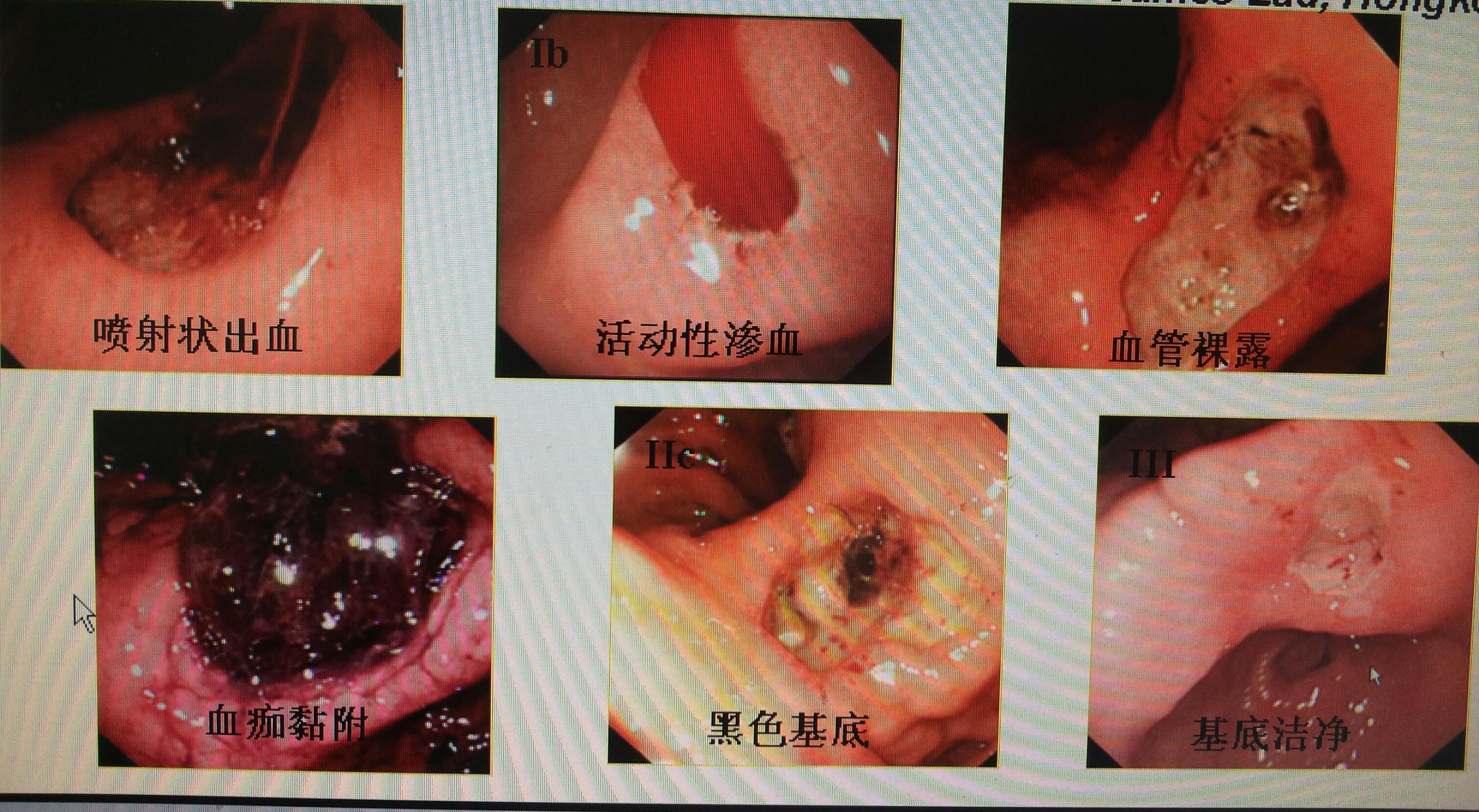 胃镜内部图片图片