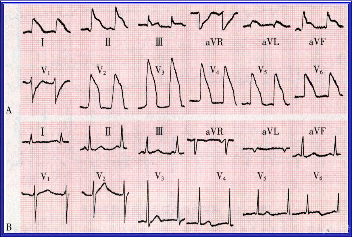 低血钙心电图图片