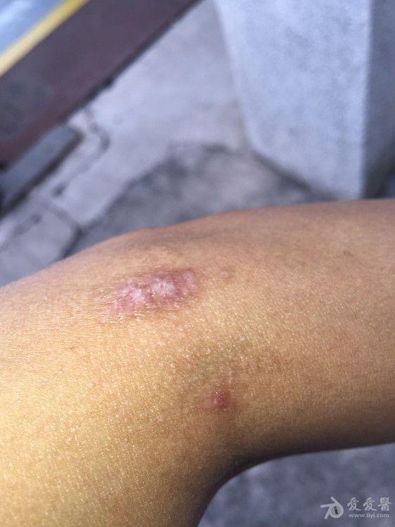 个位老师帮我看看这是扁平苔癣吗