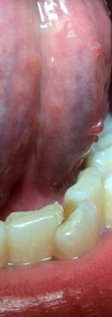 左面舌体上是什么？