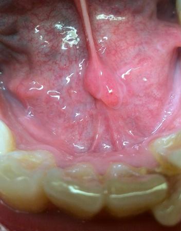 口腔正常组织还是囊肿？