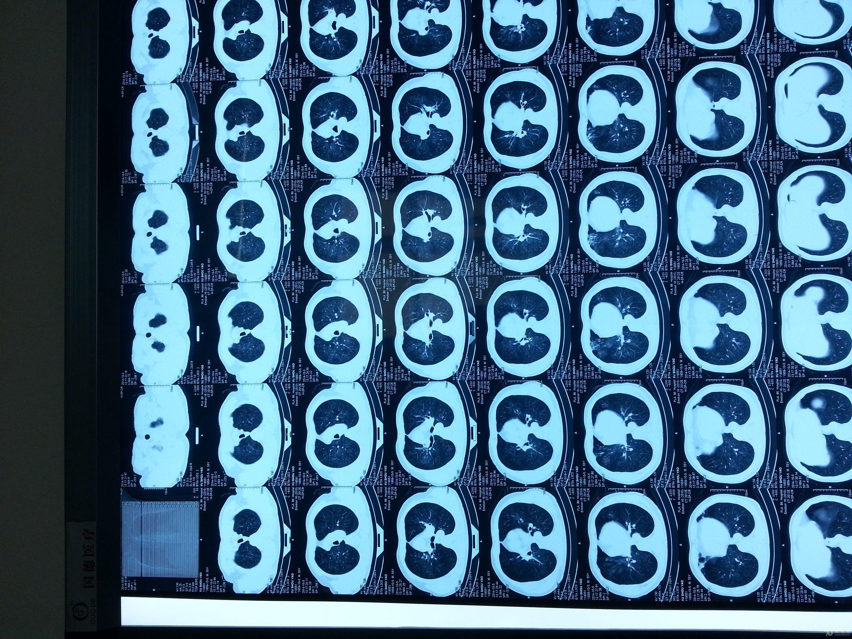 淹溺後的胸部ct - 呼吸內科專業討論版 - 愛愛醫醫學論壇