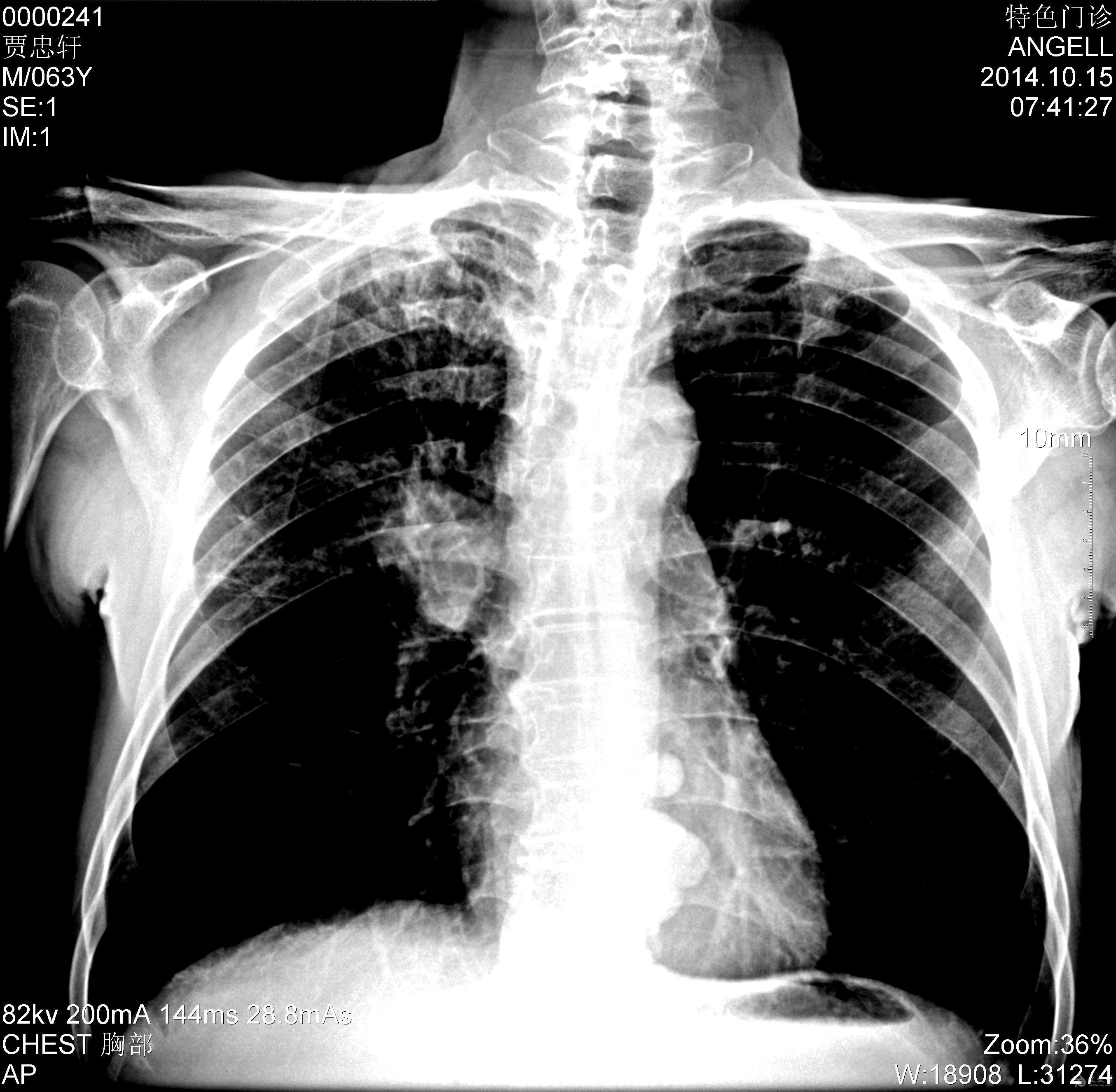 肺癌的片子是啥样的图片