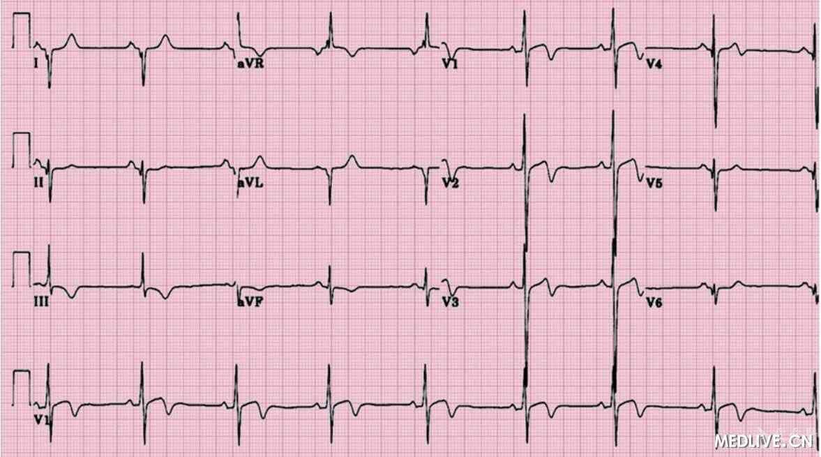 电轴右偏的心电图图片
