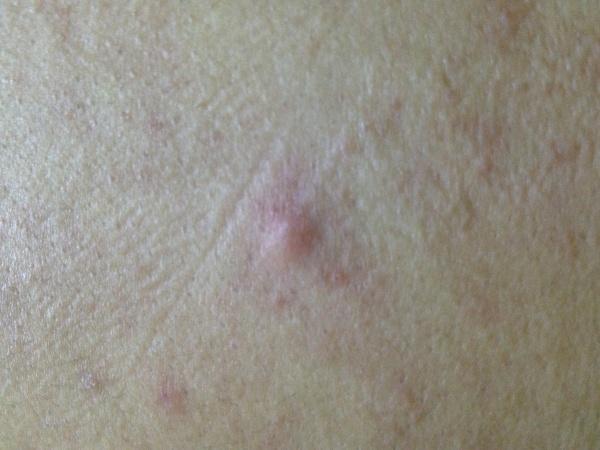 这个是皮肤不清洁时总长的疖子