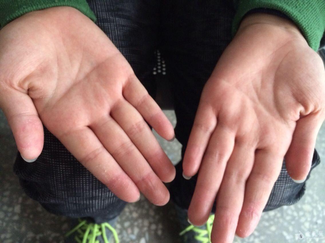 1进行性掌指角化症2足癣