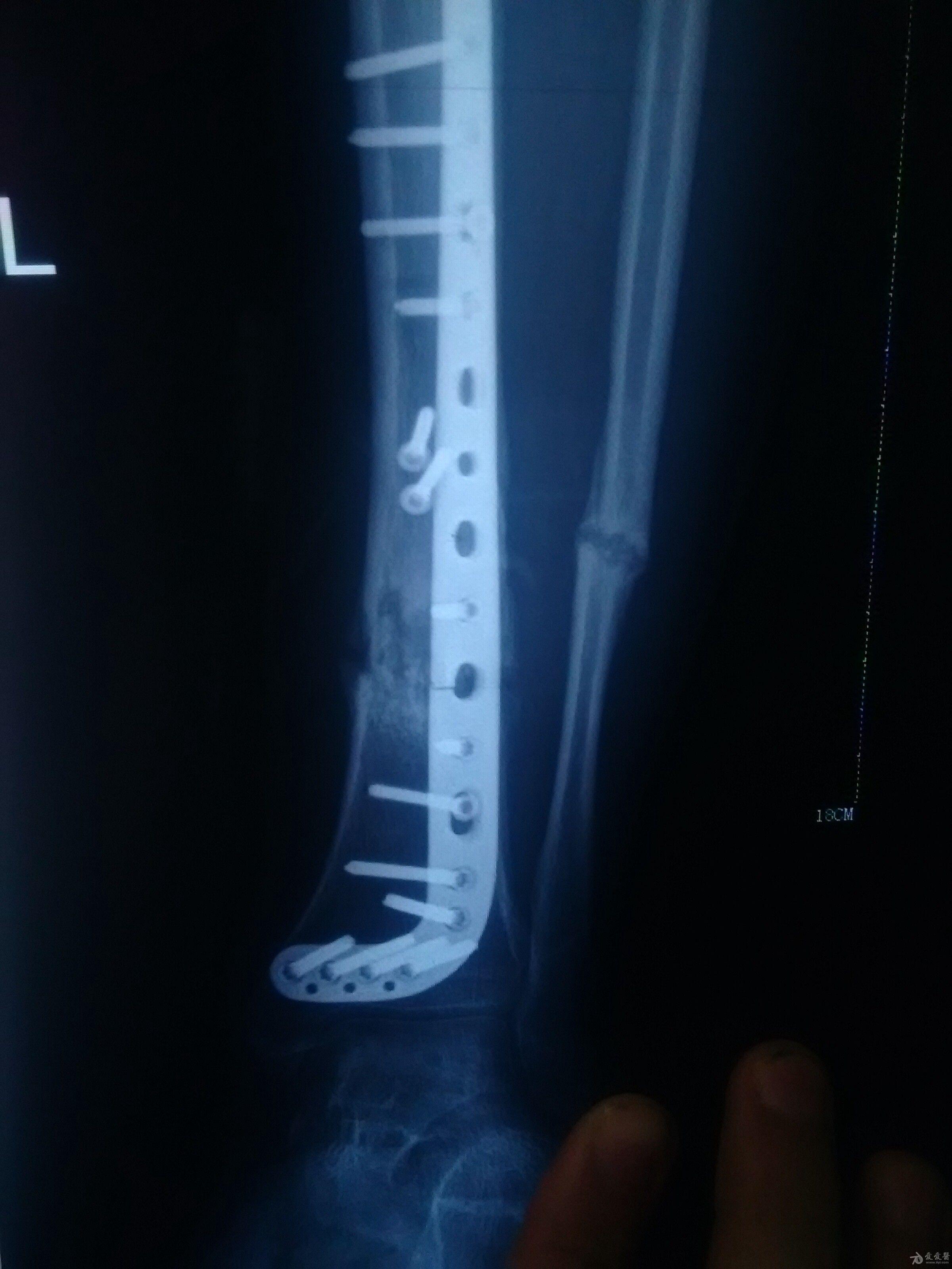 胫腓骨9个月复查钢板断了