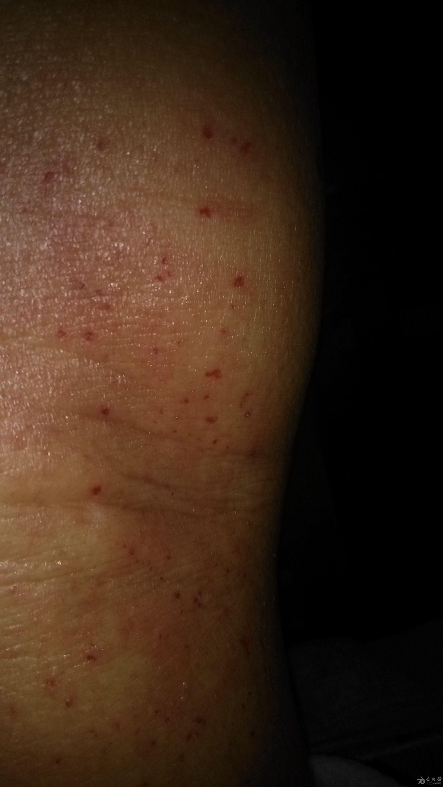 请各位老师指点，这是疥疮或者湿疹或者其他的真菌感染u2026u2026 - 皮肤及性 