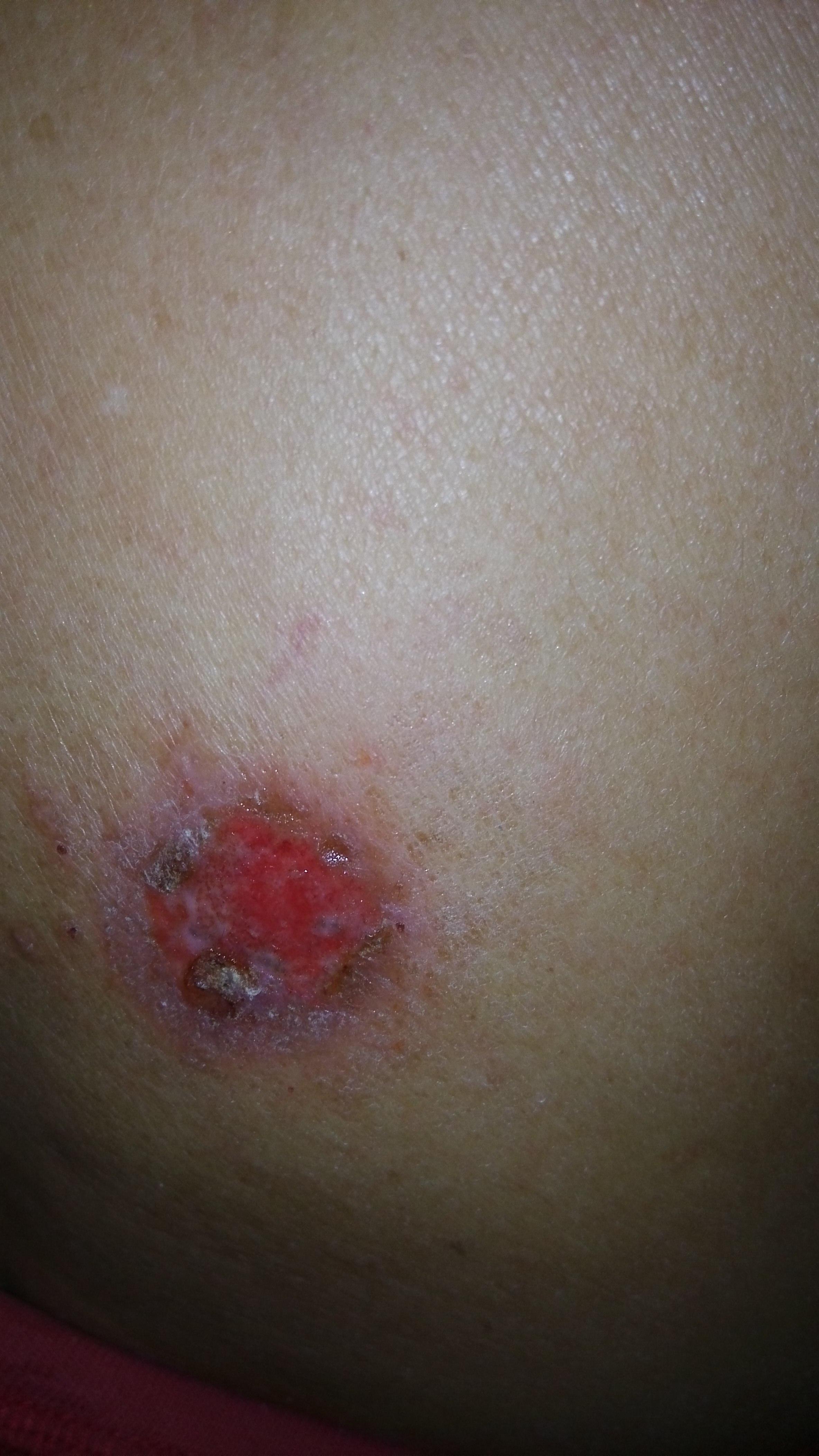 三伏贴过后皮肤过敏