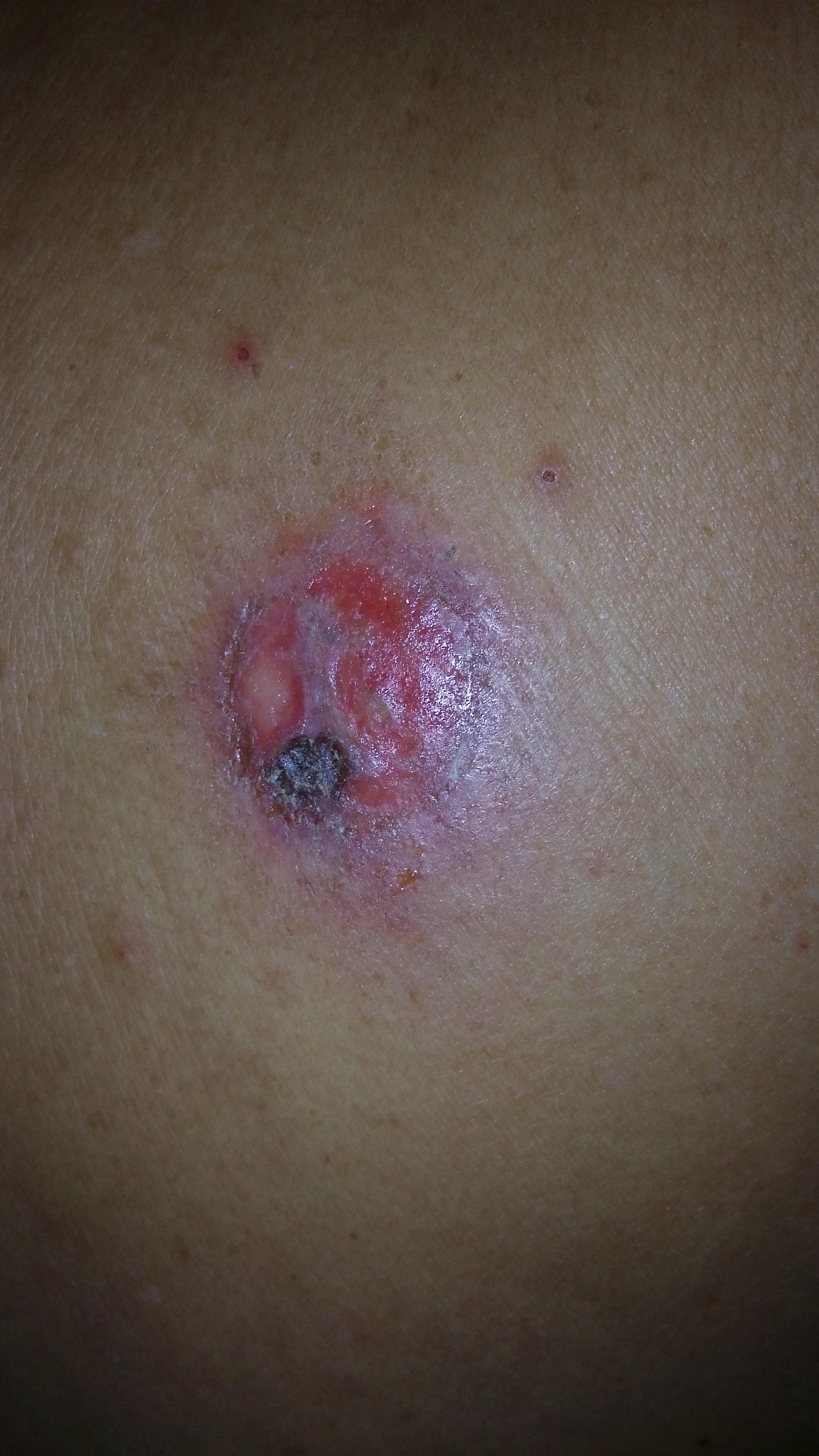 三伏贴过后皮肤过敏