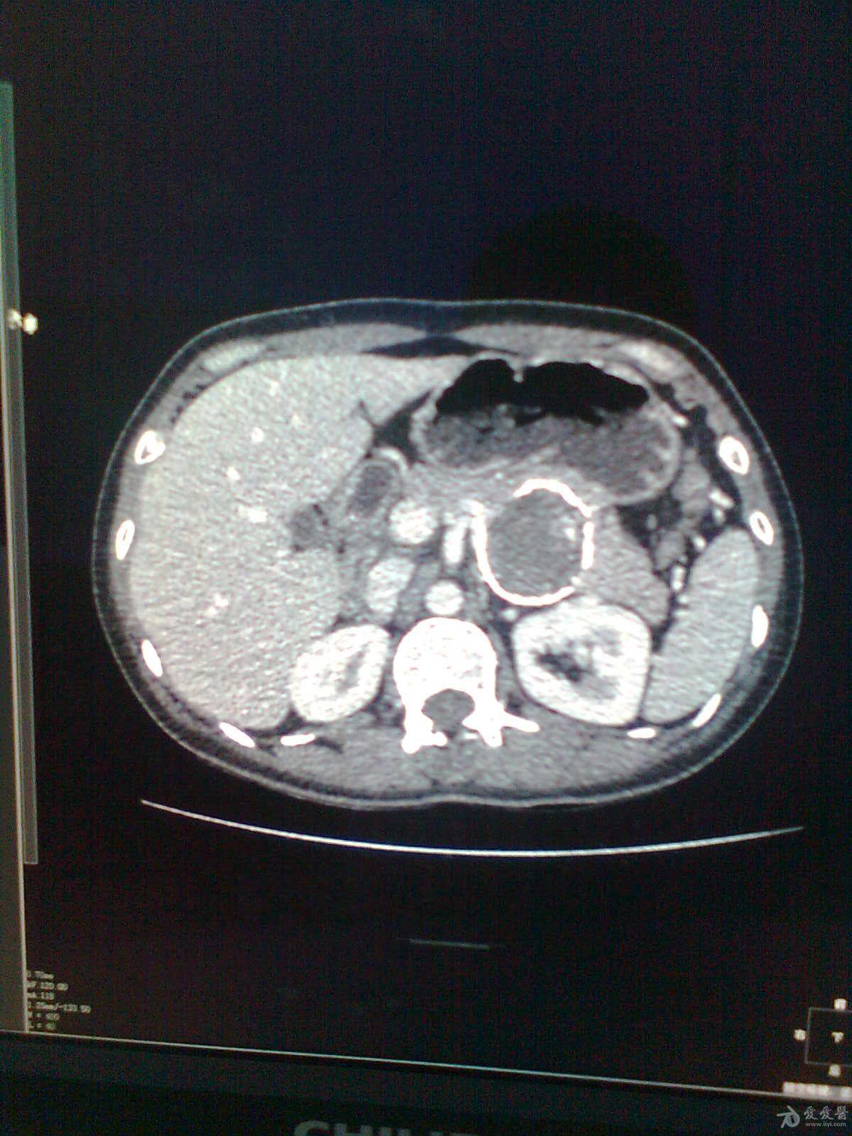 环状胰腺ct表现图片