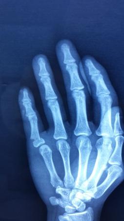 小指骨折钢板固定 骨科与显微外科专业讨论版 爱爱医医学论坛