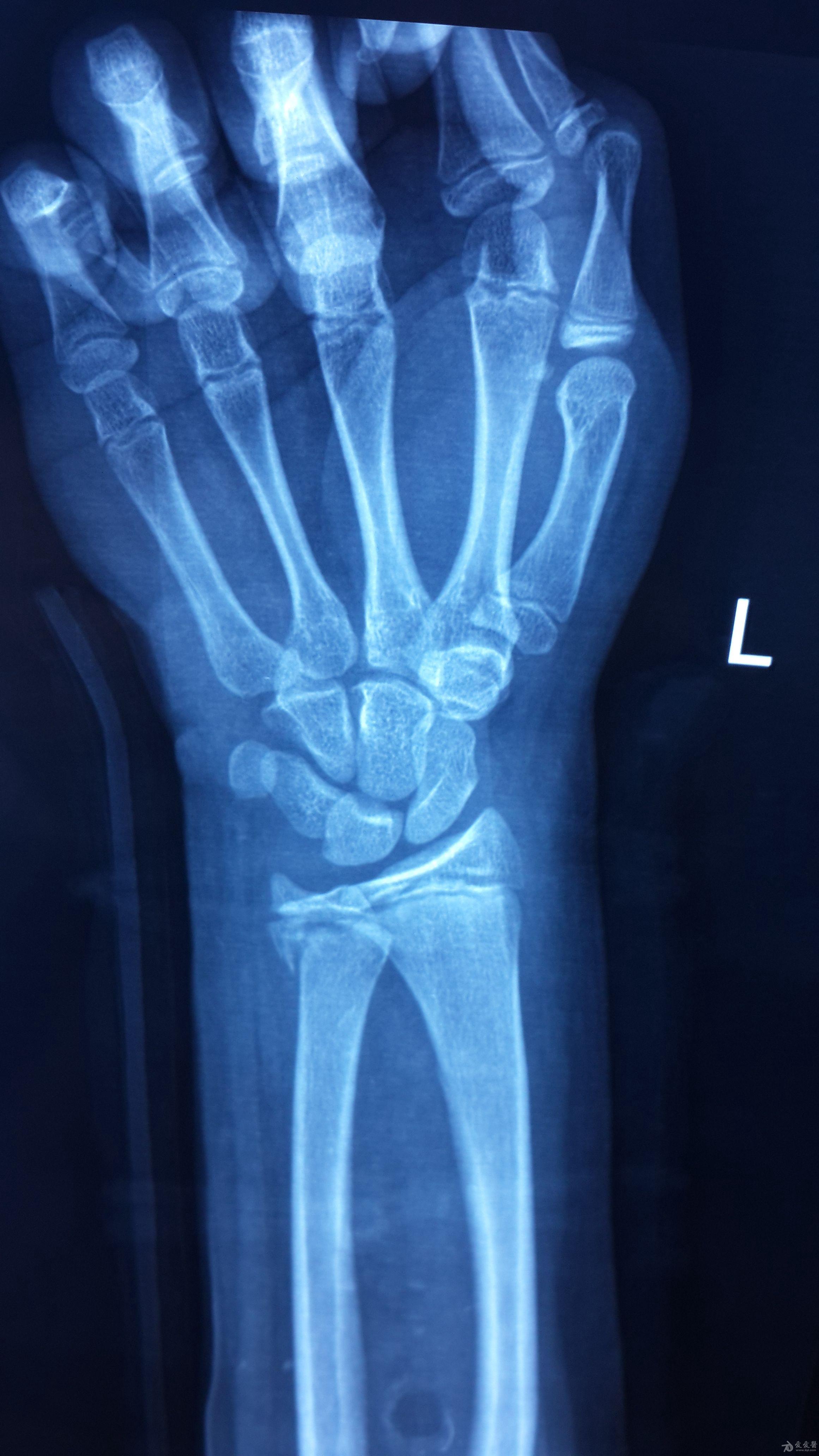 手法复位加小夹板固定治疗盖氏骨折