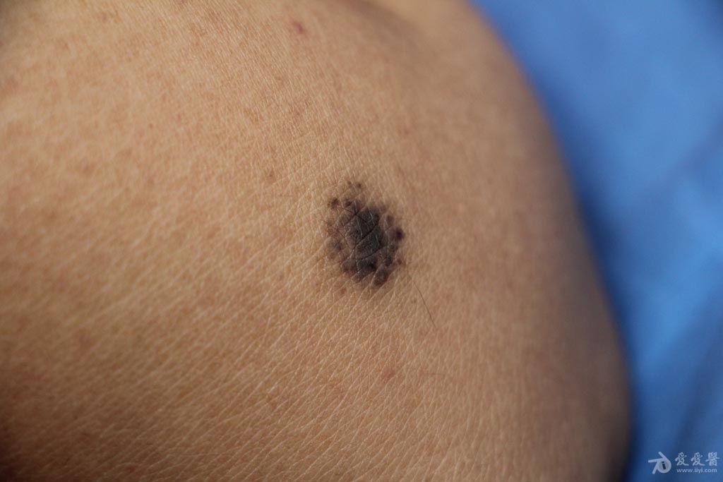 色素痣手术. - 皮肤及性传播疾病讨论版 - 爱爱医医学论坛