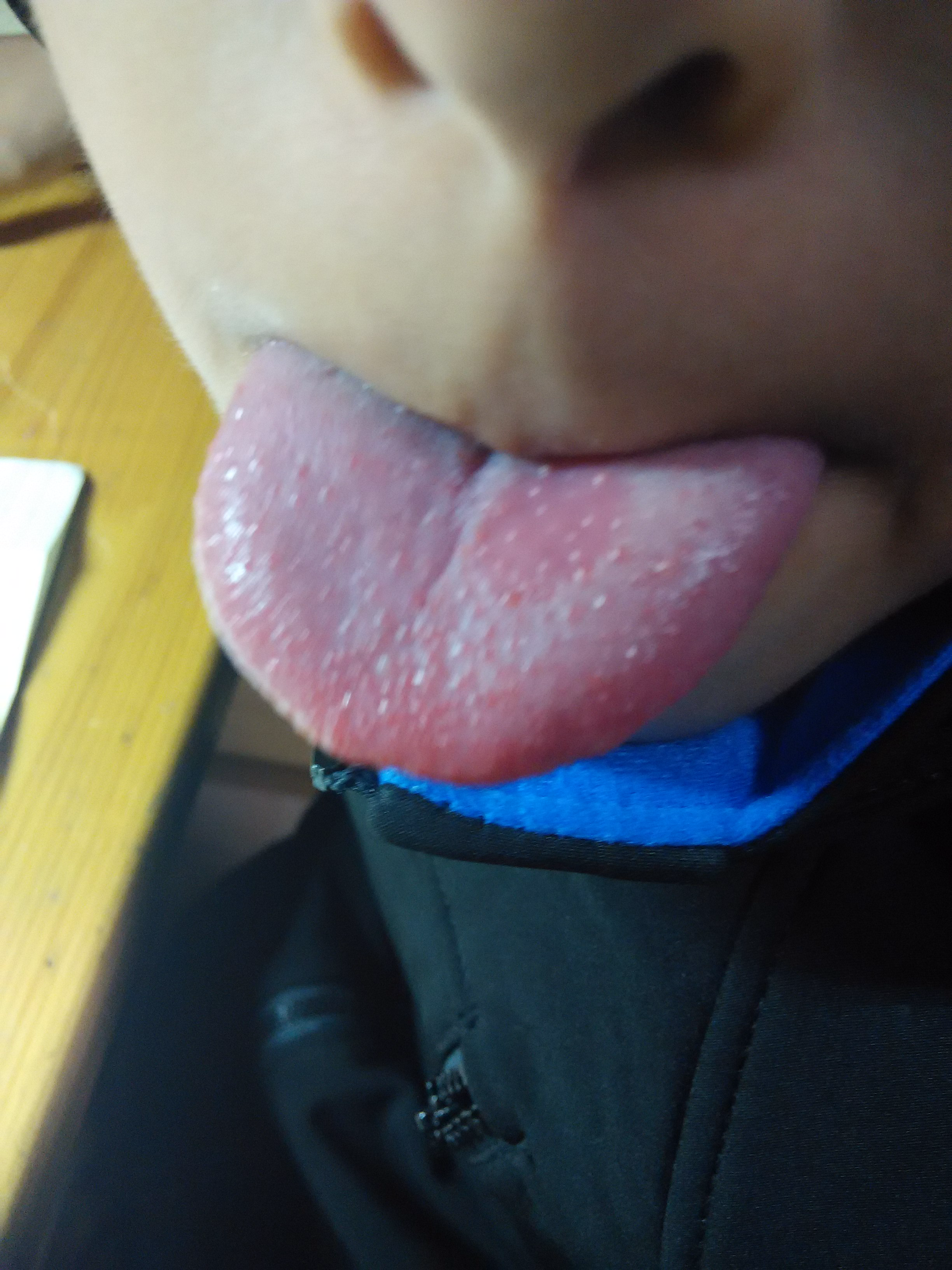 舌头上圆形红斑图片图片