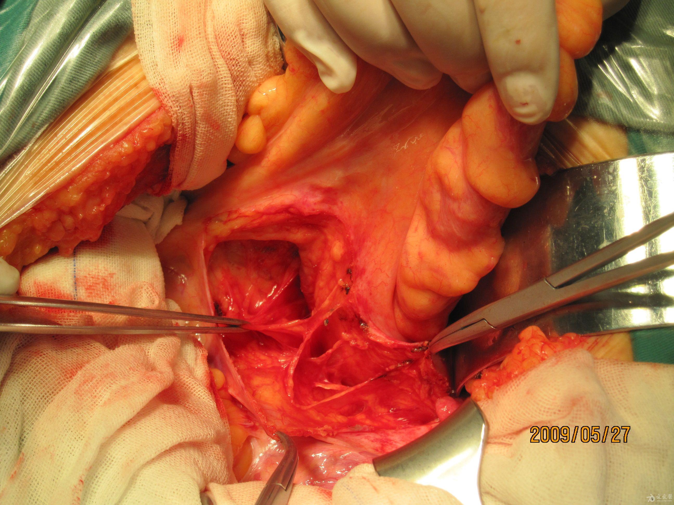 直肠癌图片乙状结肠系膜后间隙下腹下神经分支显露