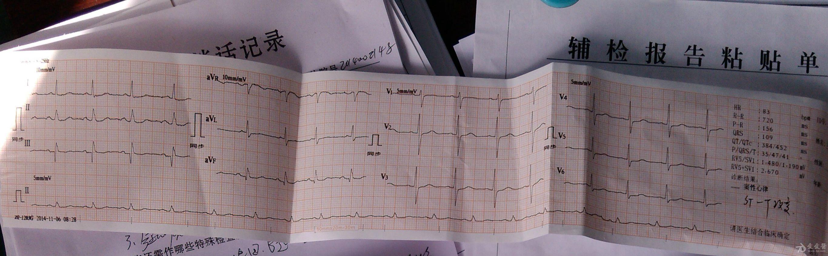 患者心跳骤停前3分钟心电图求分析