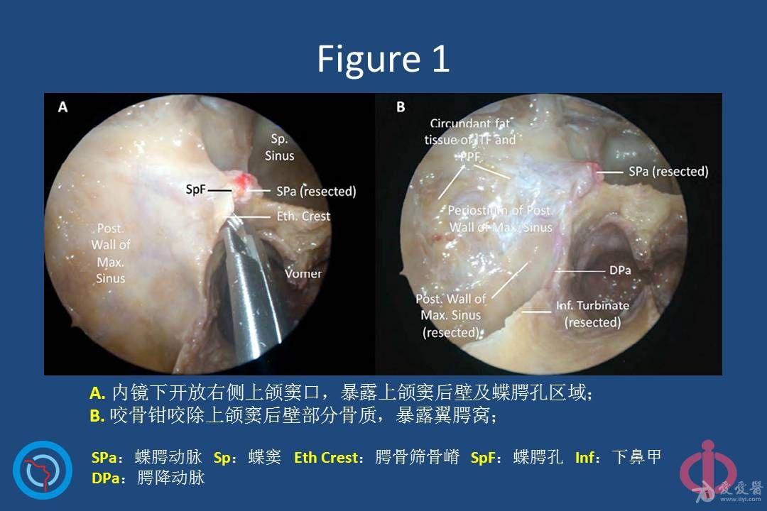 内镜下经鼻腔切除翼腭窝,颞下窝和茎突后结构