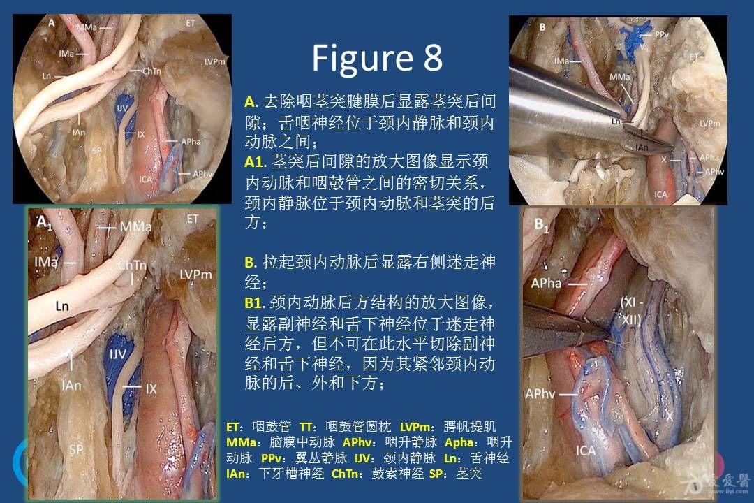 內鏡下經鼻腔切除翼顎窩,顳下窩和莖突後結構