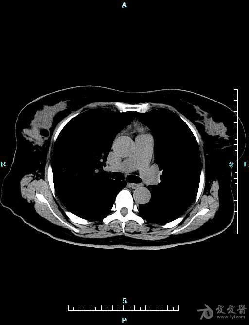 胸腺CT图片