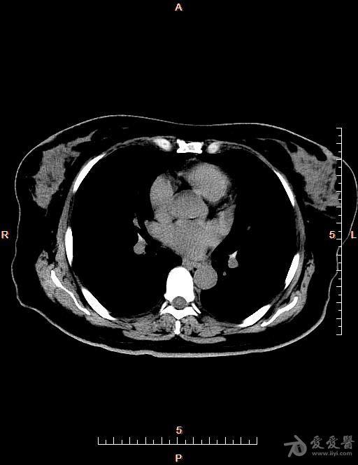 胸腺ct图像图片