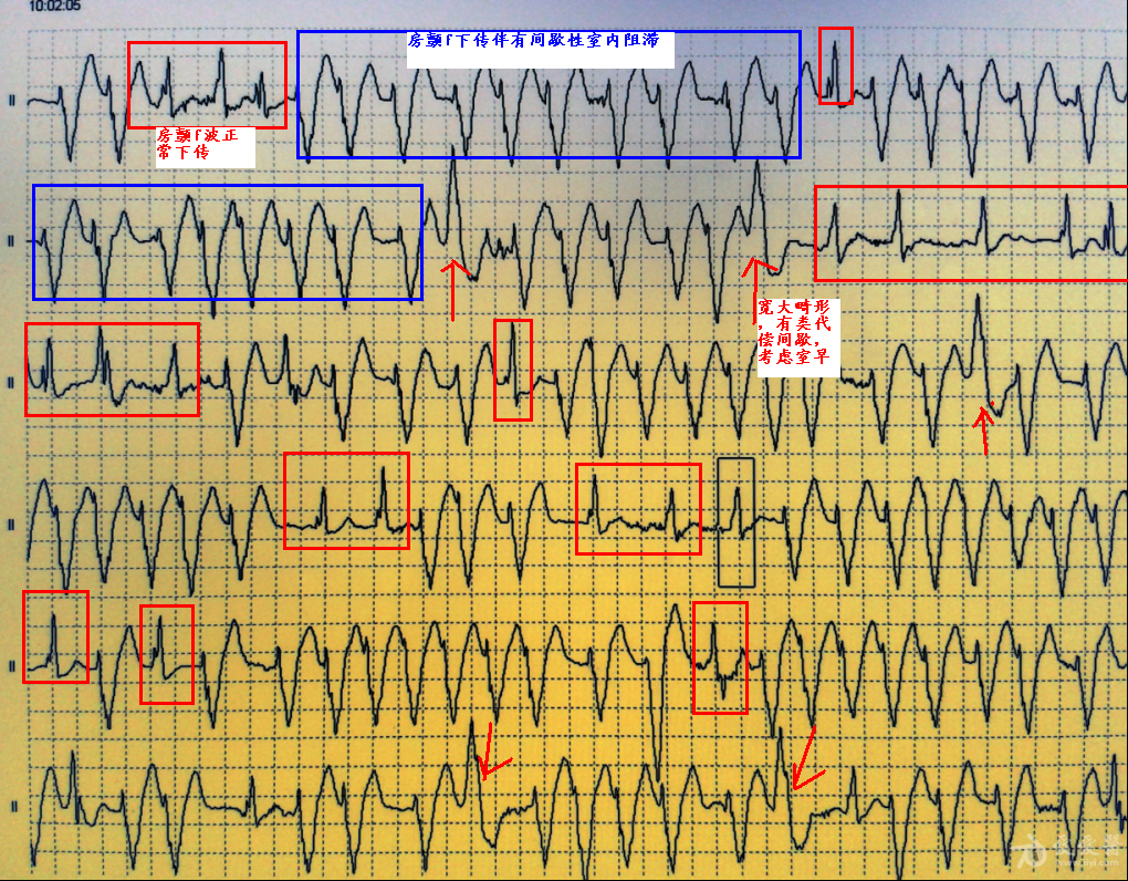 這幅圖是房顫伴差傳還是伴預激還是室速發動態心電圖繼續討論