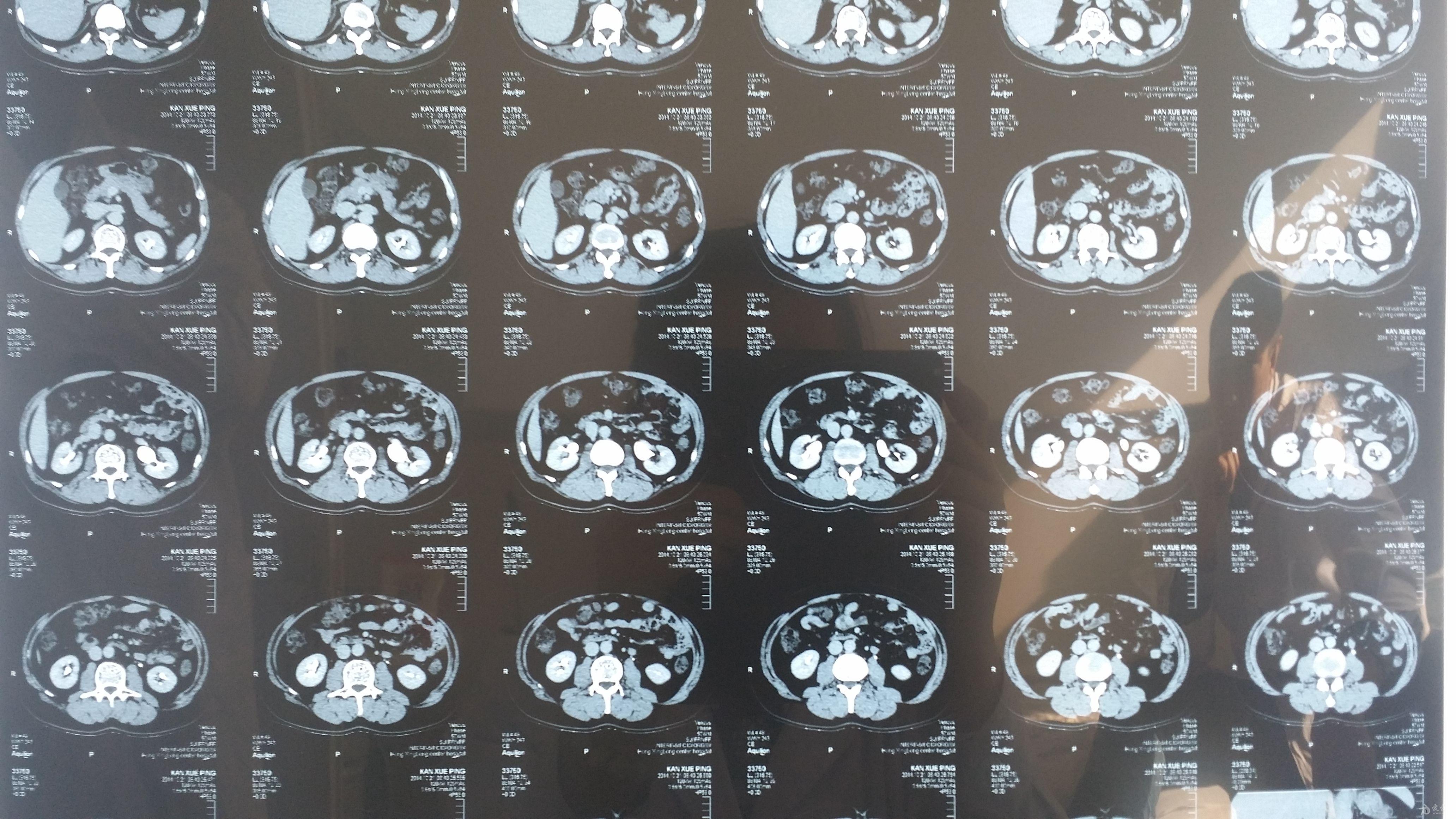 请前辈老师阅一下加强肾ct片诊断什么病