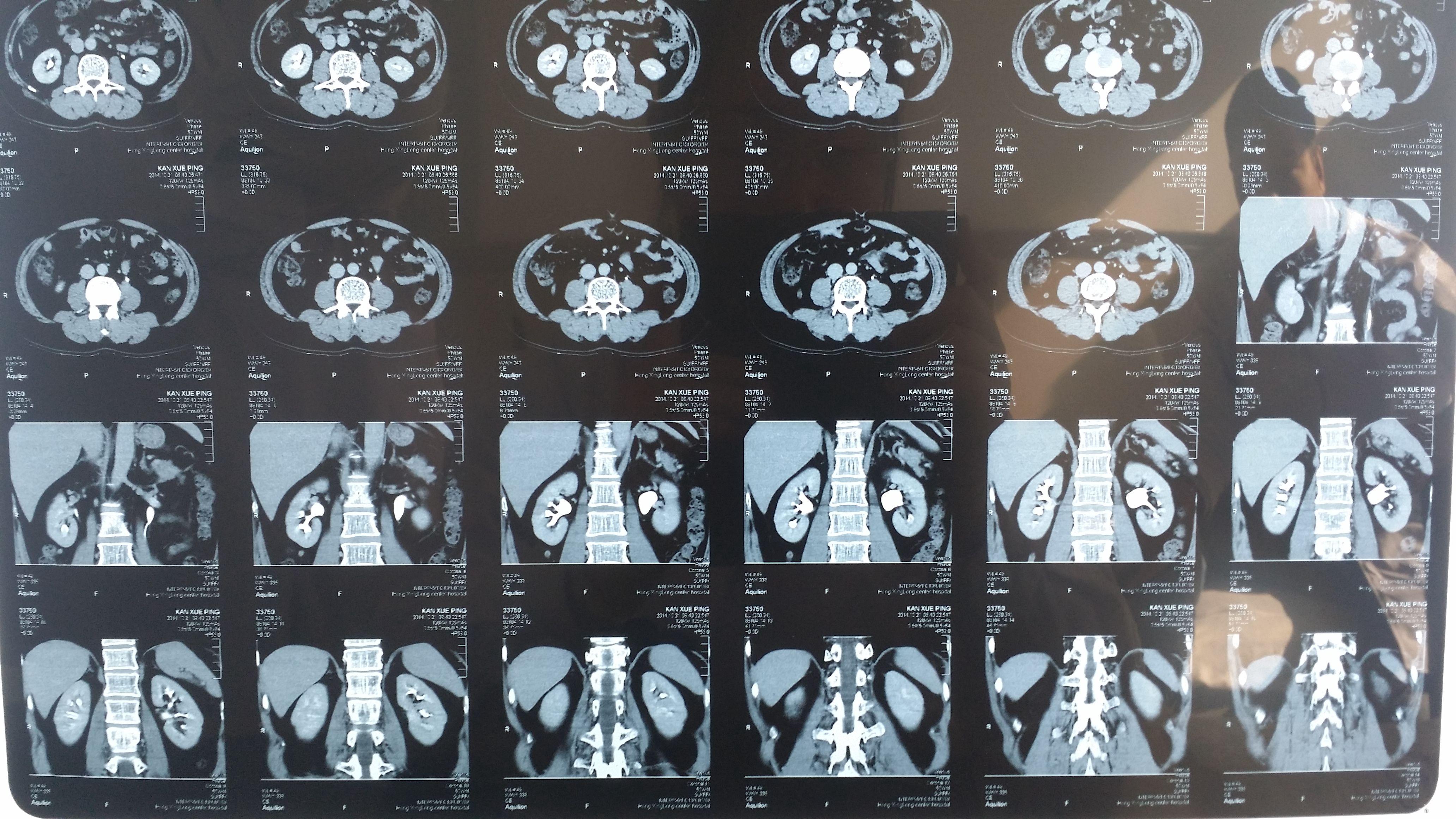 請前輩老師閱一下加強腎ct片診斷什麼病