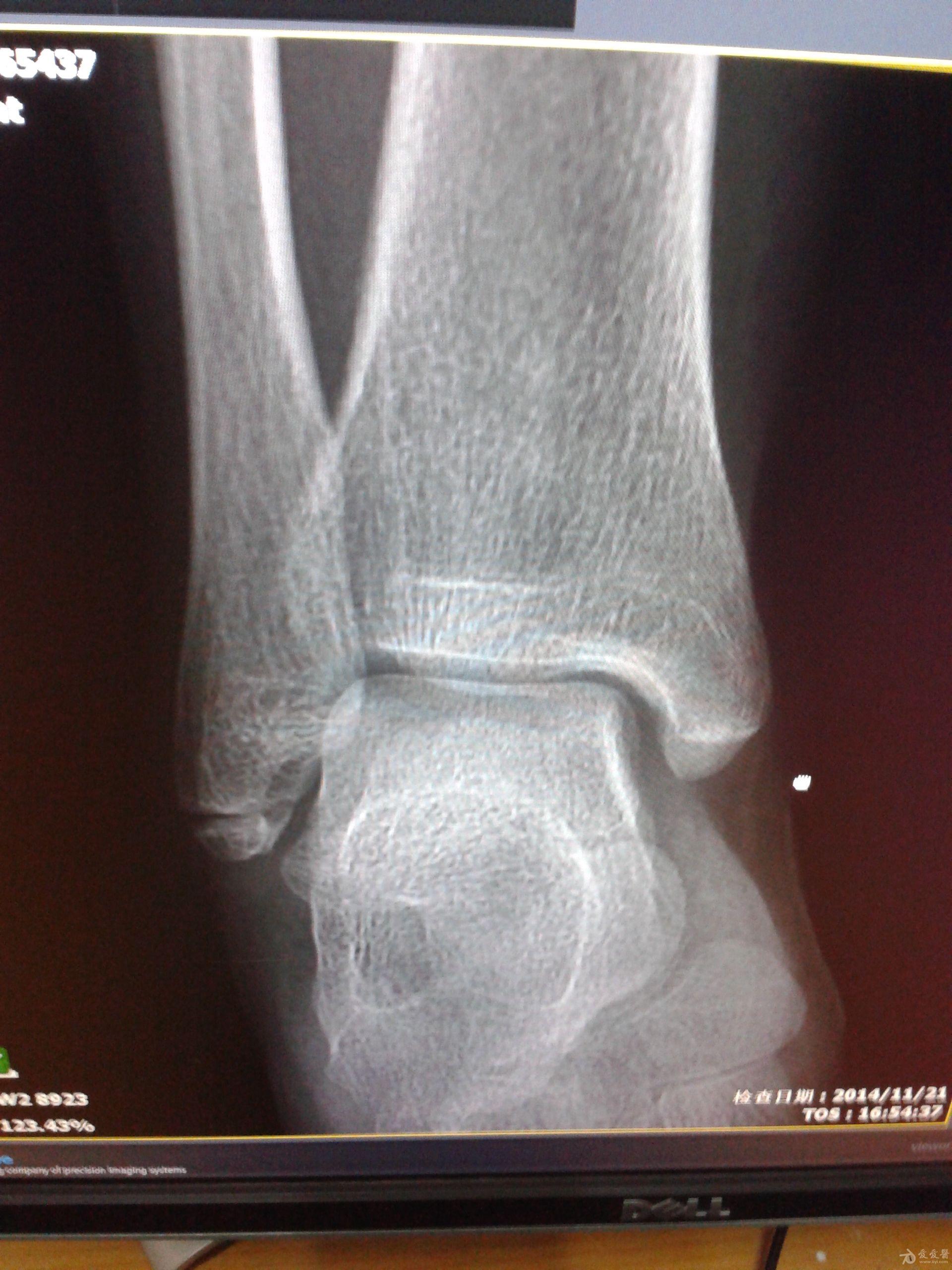 脚踝扭伤的x光图片图片