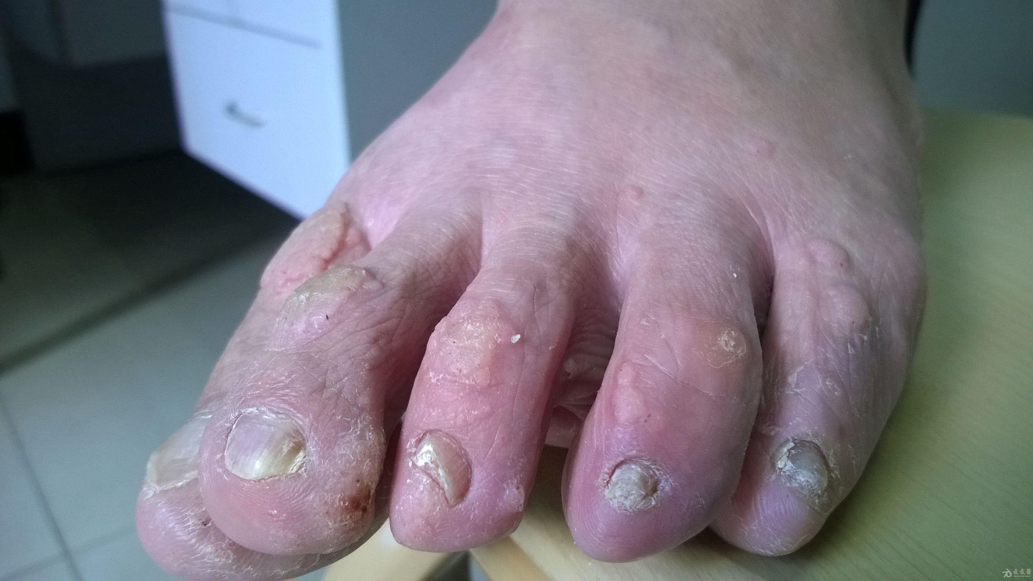 这个患者应该诊断什么皮肤病