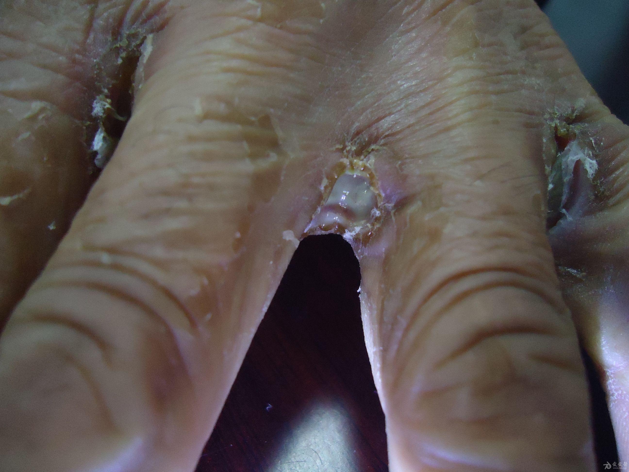 手指坏疽病初期的图片图片