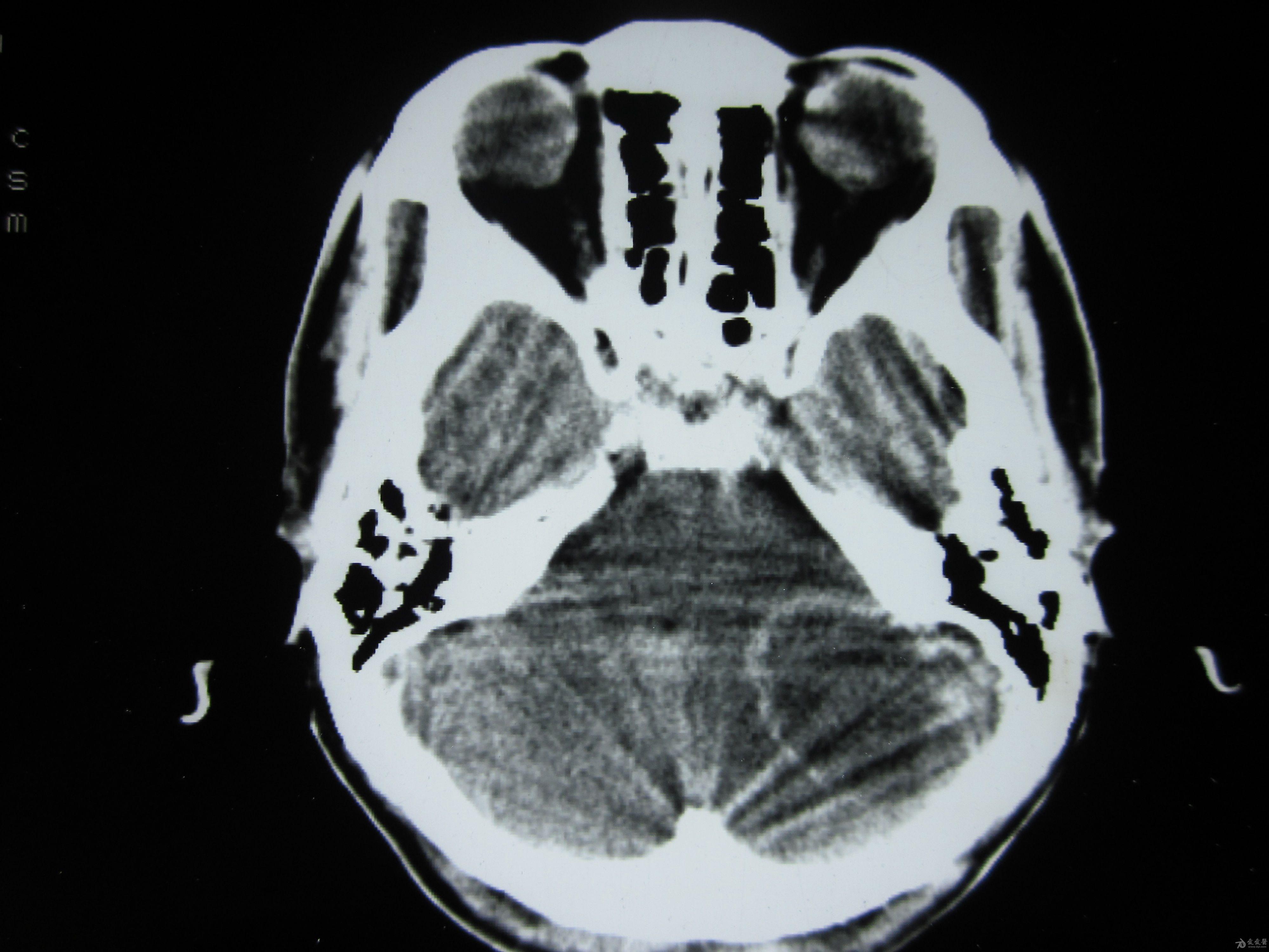 两上肺巨大对称转移瘤?