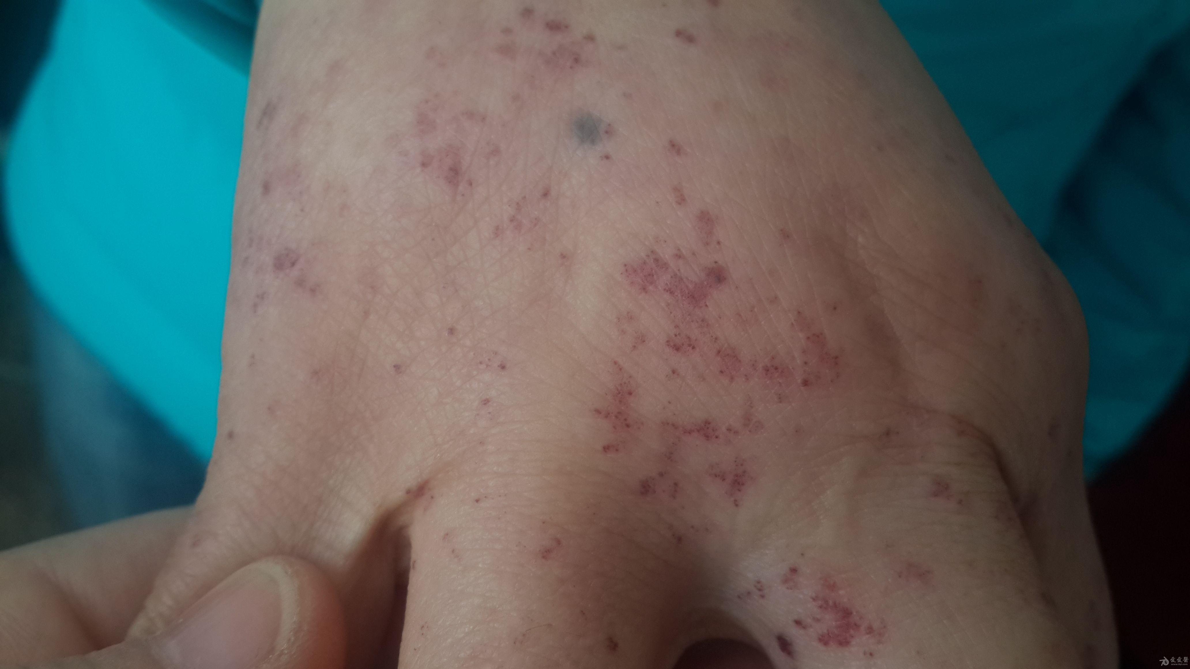 这是血管角皮瘤么