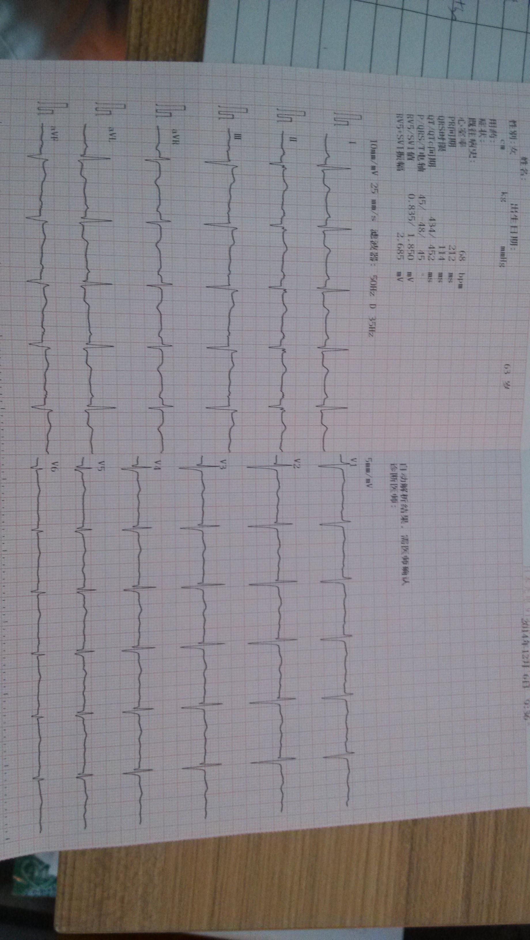 心電圖報告求幫忙分析