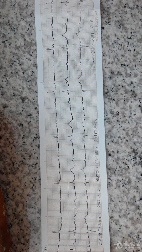 三度传导阻滞心电图图片