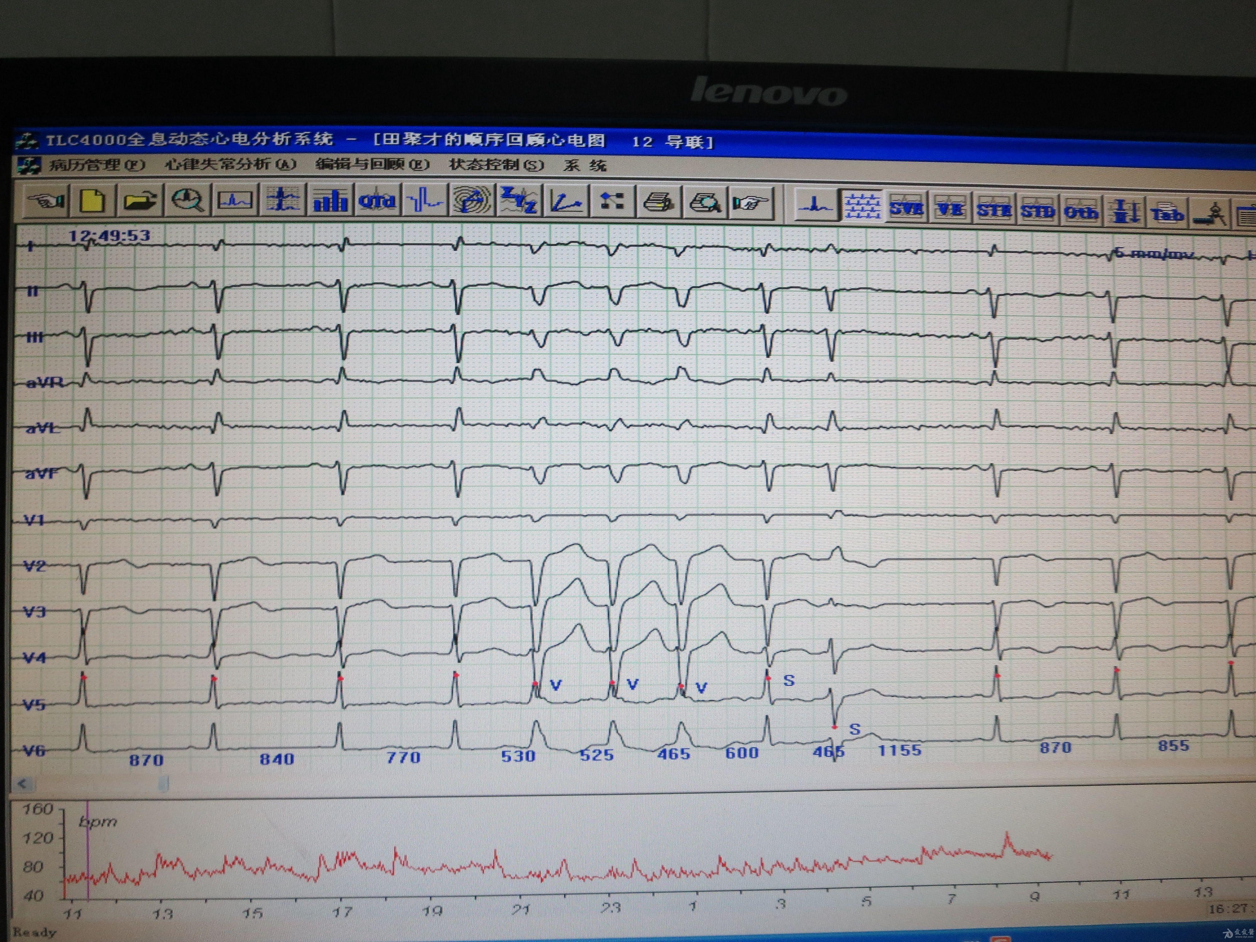 有房早及未下传,差传老师宽的是室速吗有时前边有逆p 心电图脑电图