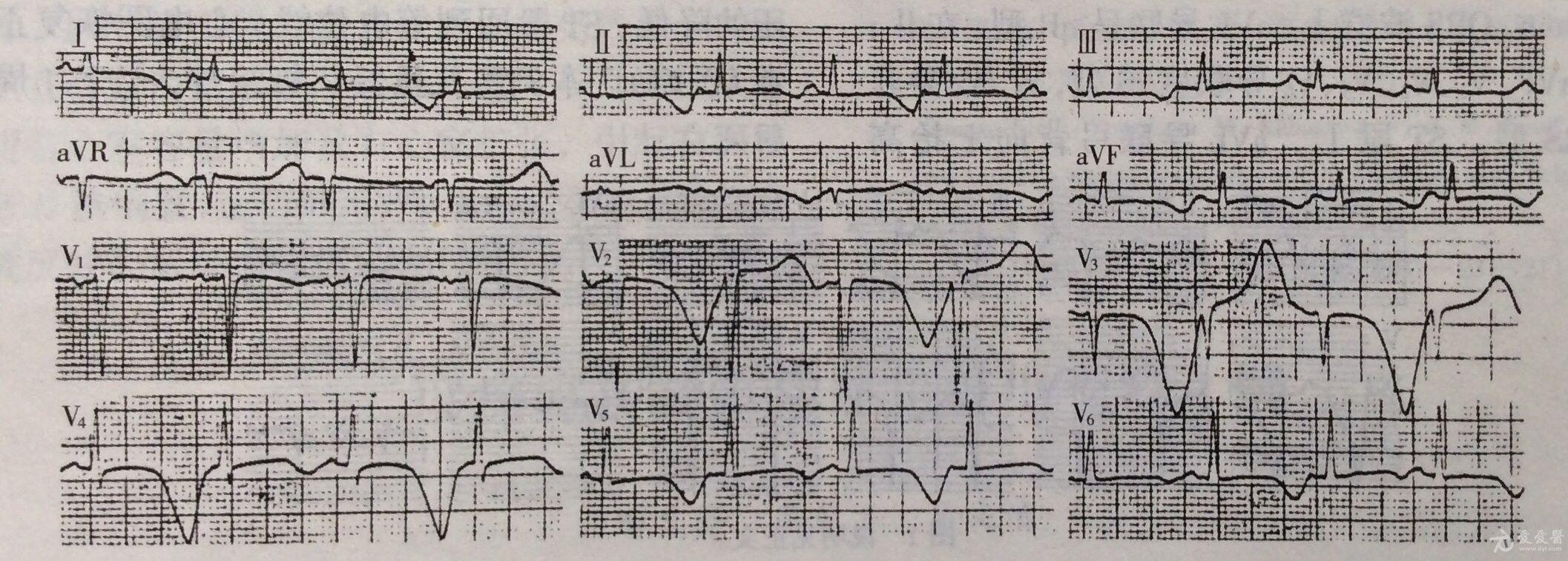 低钙血症心电图表现图片