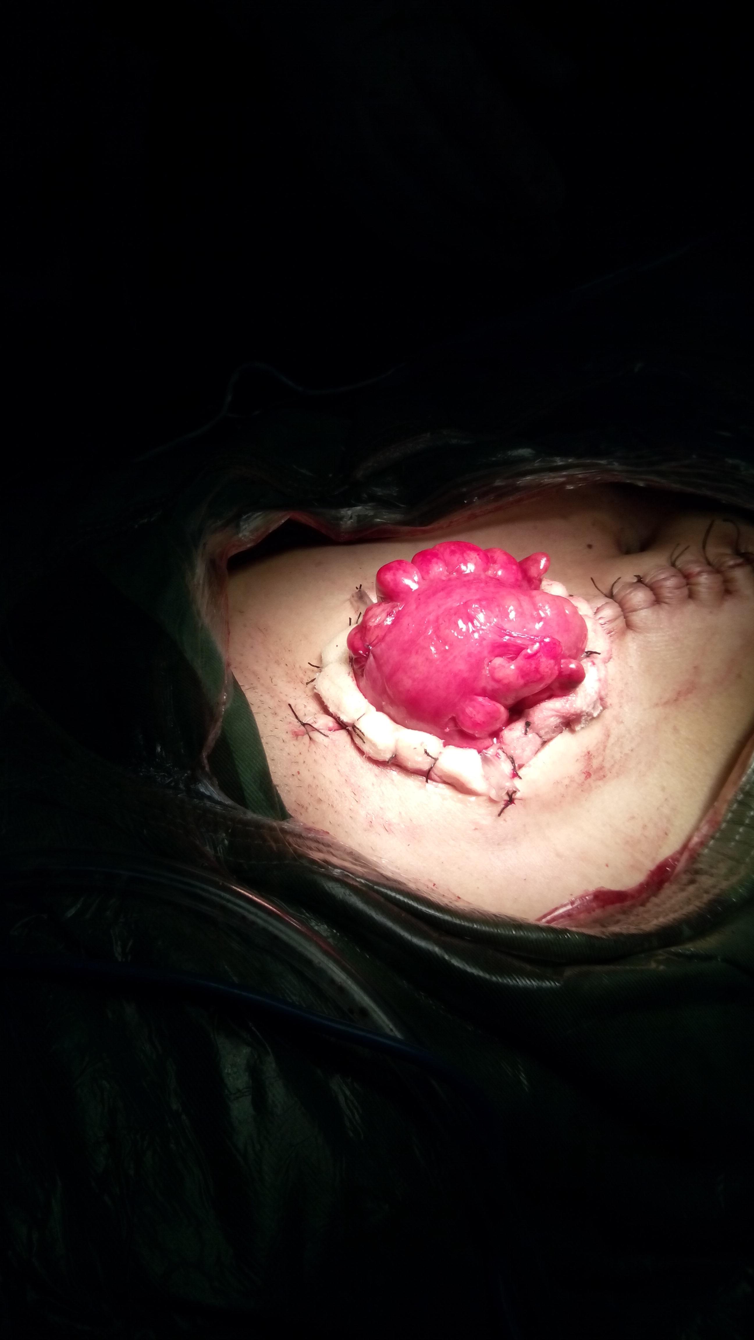 肠穿孔手术图片图片