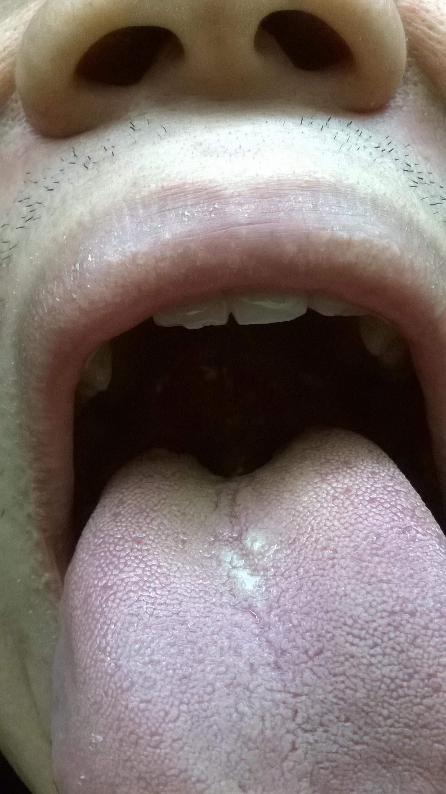 舌隆突增生图片图片