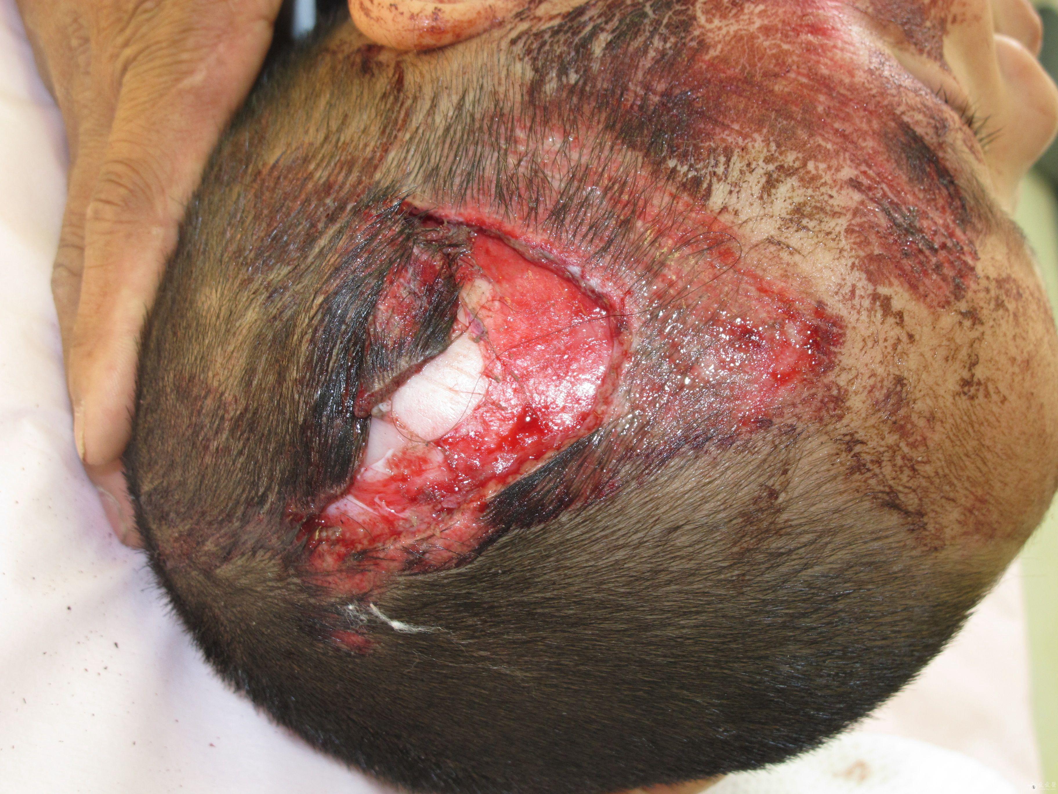 头部微创手术伤口图片图片