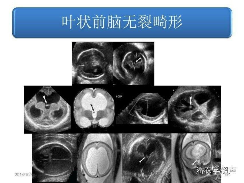 胎儿叶状全前脑误诊图片