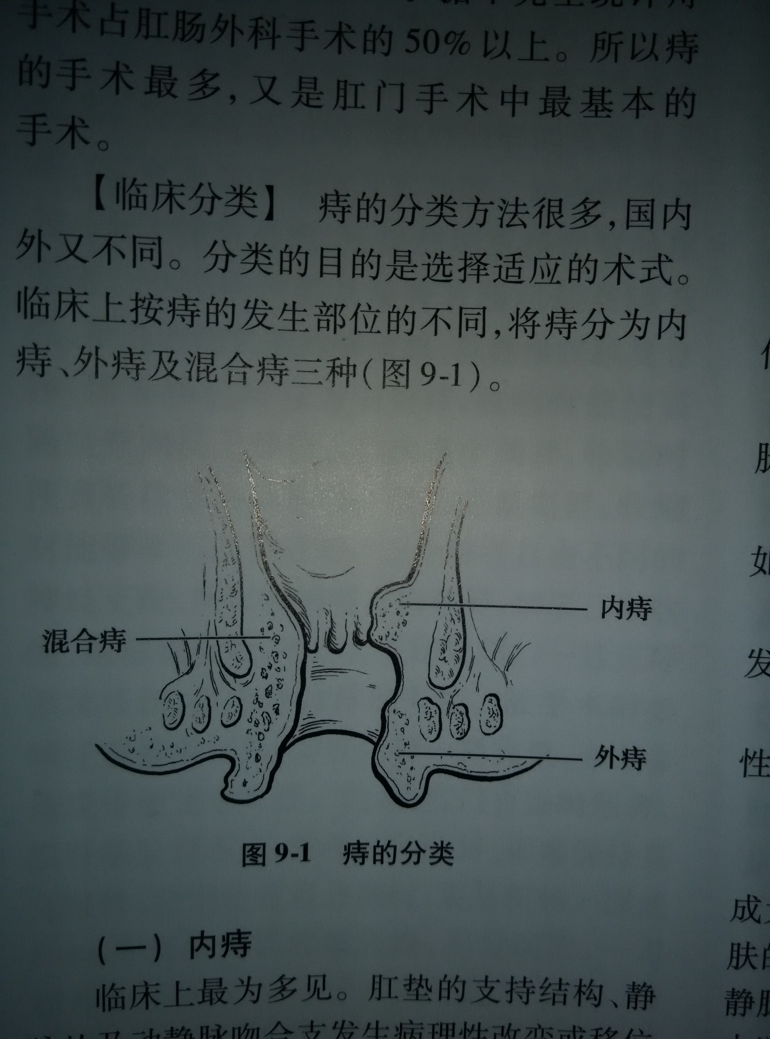 请教各位老师关于齿状线,内痔,混合痔的知识.