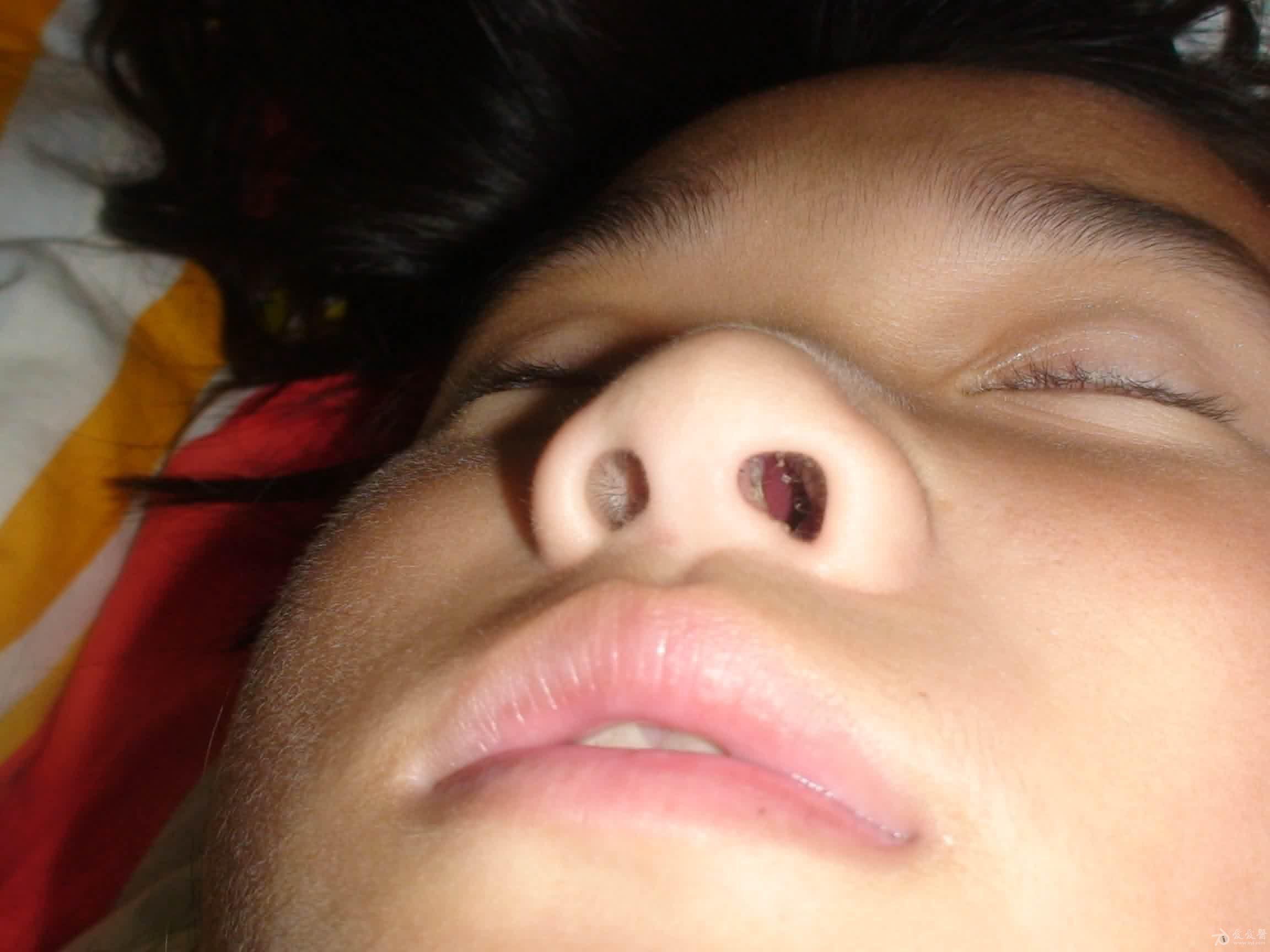 求助女儿鼻子到底是什么病